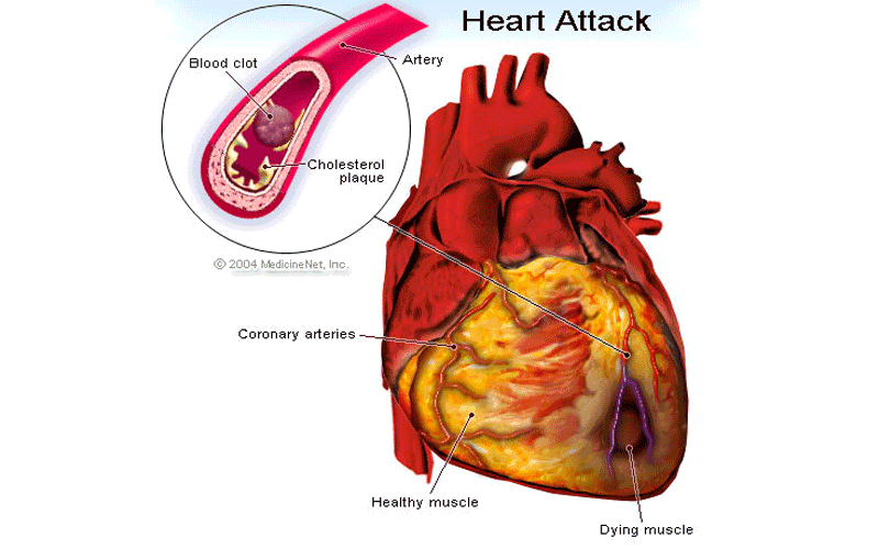 Coronary Artery Disease Effect