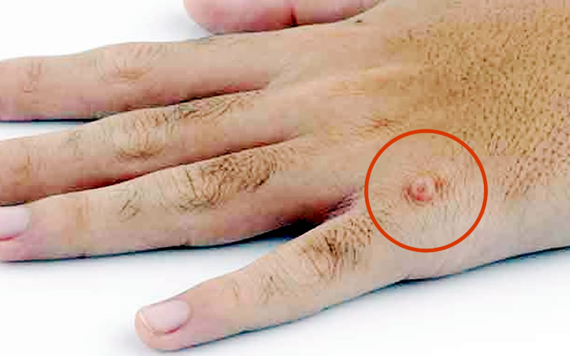 How To Treat Warts Easily