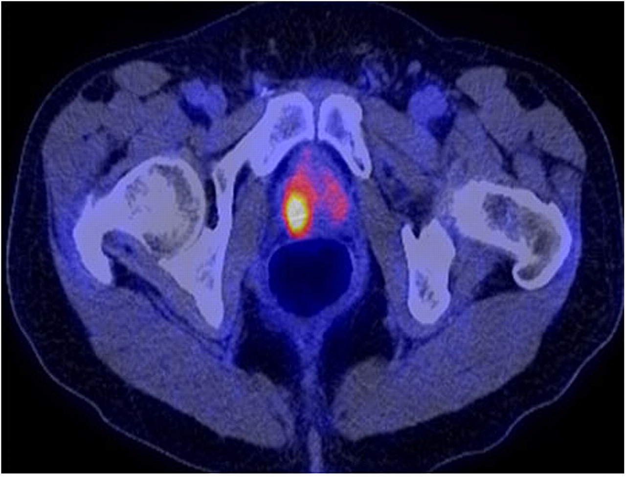 First Human Application Of Novel Pet Tracer For Prostate Cancer