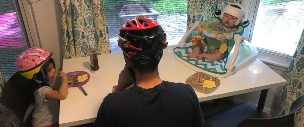 Family sports helmets in solidarity with 4-month-old baby diagnosed with plagiocephaly