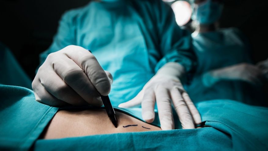 Is liposuction safe for people with type 2 diabetes?