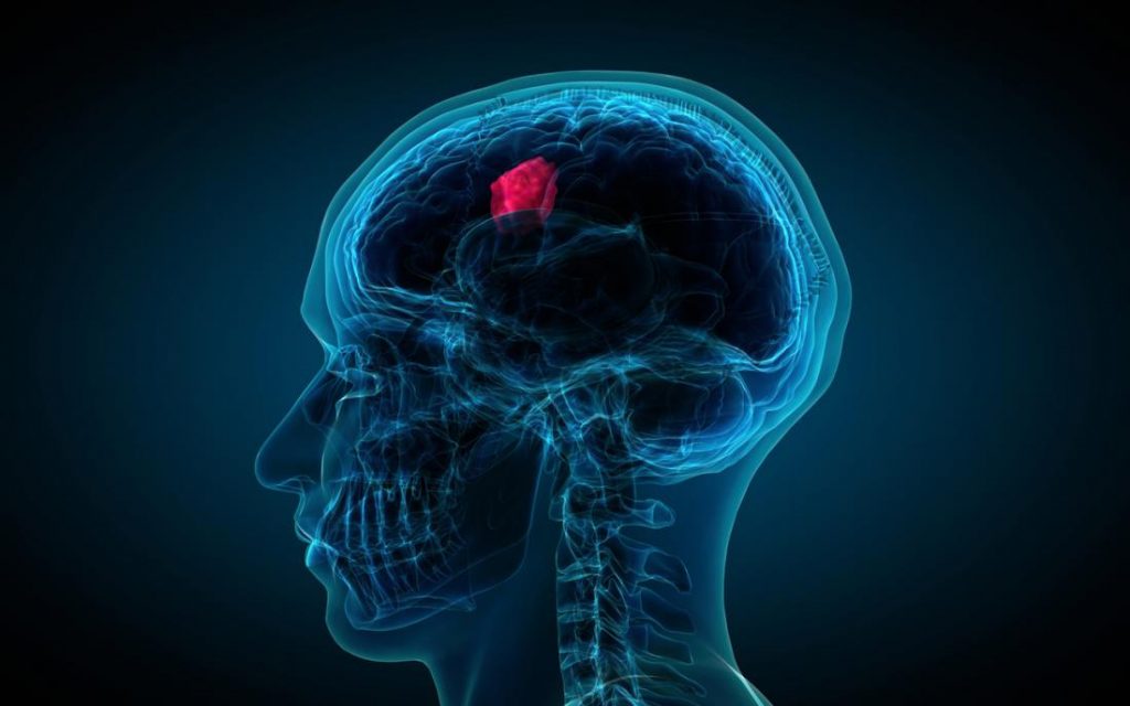 A new treatment for this deadly brain tumor?