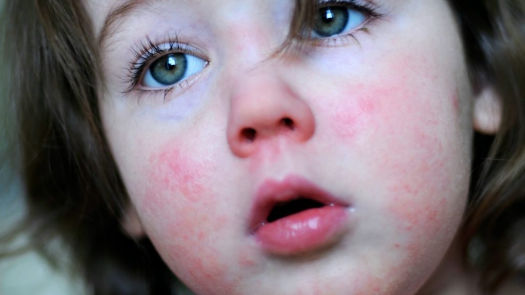 Scarlet fever cases hit 50-year high in England